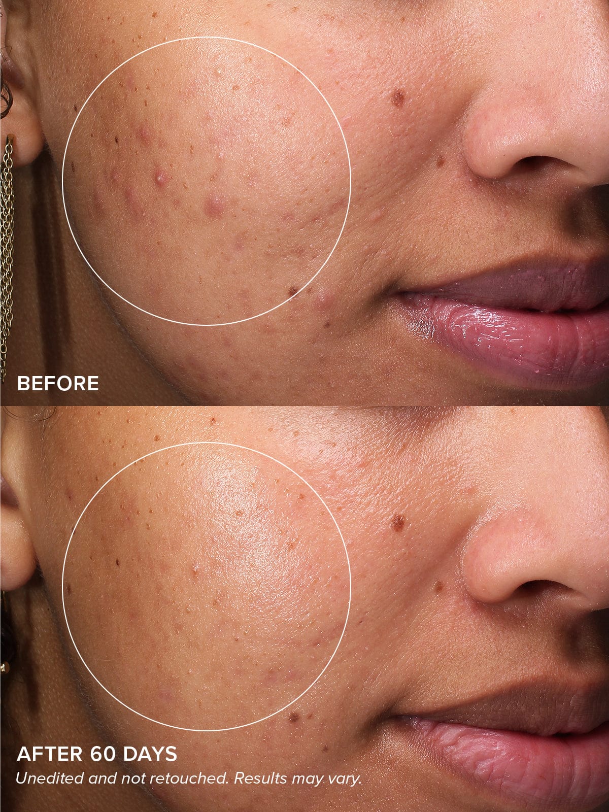 Gentle Acne Serum - Image 5