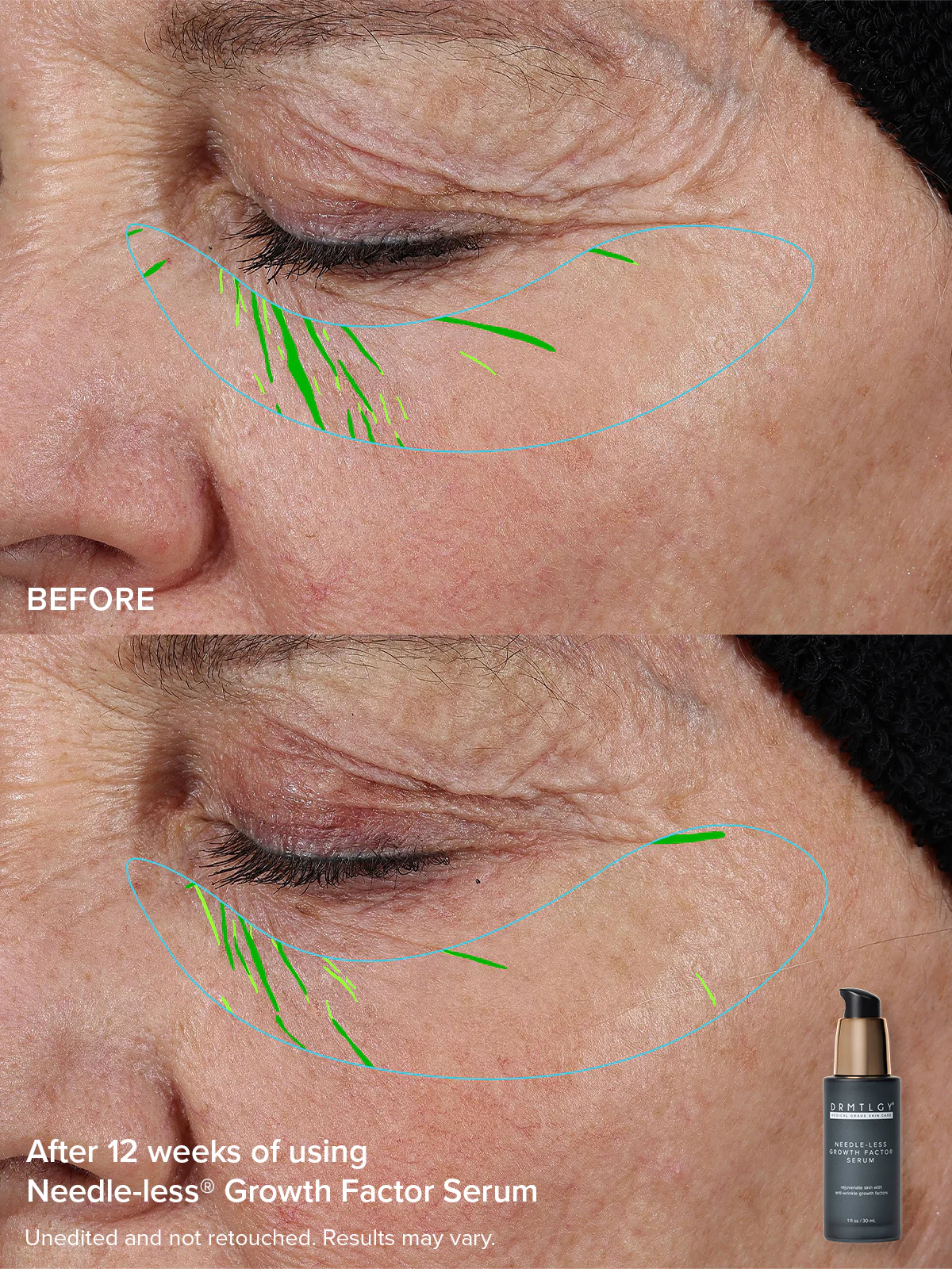 The Needle-less® Duo - Image 6